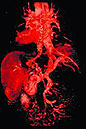 Magnetresonanztomografie von Ösophagusvarizen bei ausgeprägter Leberzirrhose. 