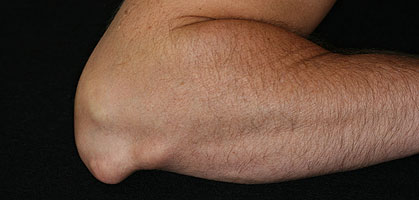 Das Zipperlein der Biertrinker - Orthopädie - derStandard