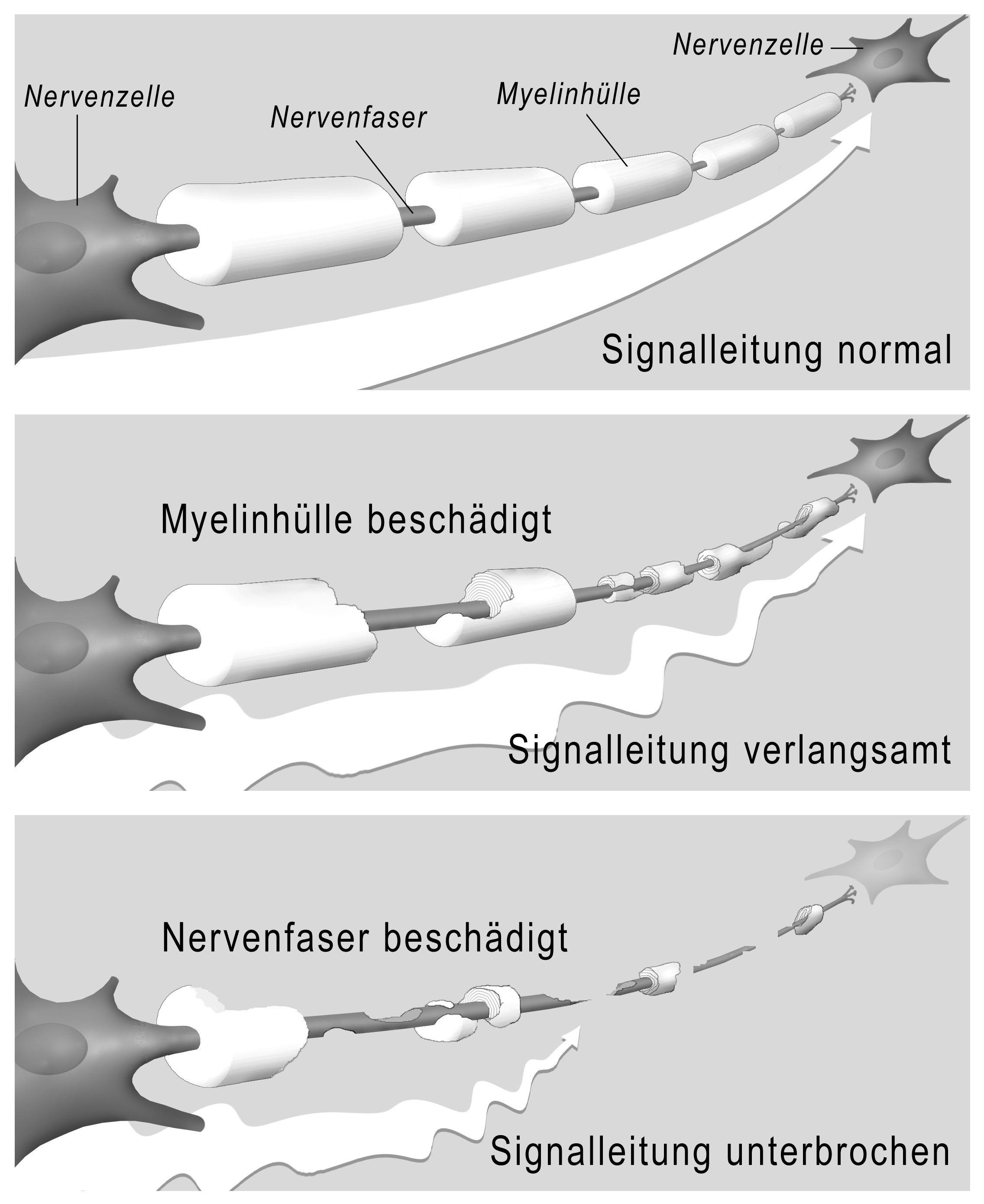 Wenn Nerven blank liegen Multiple Sklerose derStandard.at › Gesundheit