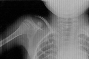 foto: osteogenesis imperfecta austria