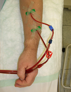 Im arteriellen Schlauch (rot) befindet sich das zu reinigende Blut, im venösen Schlauch (blau) das "gewaschene" Im arteriellen Schlauch (rot) befindet sich das zu reinigende Blut, im venösen Schlauch (blau) das "gewaschene"