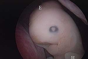 Embryoskopische Untersuchung des Embryos direkt vor der Curettage. Der Embryo zeigt multiple Entwicklungsdefekte. Embryoskopische Untersuchung des Embryos direkt vor der Curettage. Der Embryo zeigt multiple Entwicklungsdefekte.