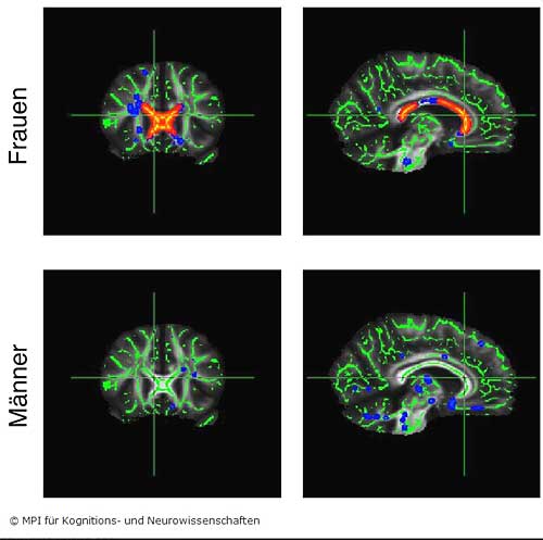 Bei übergewichtigen Frauen traten im Corpus callosum größere Veränderungen (rot markiert) auf als bei den männlichen Testpersonen.