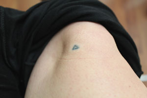 Heute kommt das Knie der Reporterin an die Reihe. "Am schnellsten lässt sich vor vielen Jahren selbst Gestochenes entfernen", sagt Brigitte Klein. Heute kommt das Knie der Reporterin an die Reihe. "Am schnellsten lässt sich vor vielen Jahren selbst Gestochenes entfernen", sagt Brigitte Klein.
