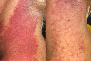 Ein Feuermal vor beziehungsweise nach viermaliger Behandlung mit dem Farbstofflaser. Ein Feuermal vor beziehungsweise nach viermaliger Behandlung mit dem Farbstofflaser.