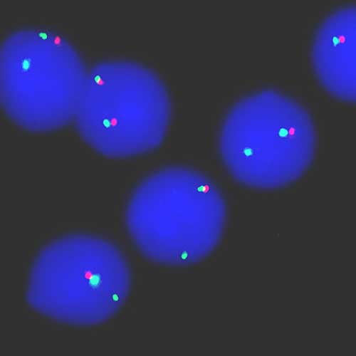 Leukämiezellen, in deren Zellkern sich lediglich ein rotes Signal findet, haben einen Teil des Chromosoms 17 verloren. Das führt zu Resistenz gegen Chemotherapie und Zelltod.