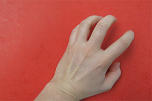 Im Falle der rheumatoiden Arthritis sind die Heilungschancen mittlerweile bei Neupatienten relativ hoch. Im Falle der rheumatoiden Arthritis sind die Heilungschancen mittlerweile bei Neupatienten relativ hoch.