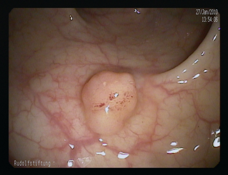 Gutartiger Dickdarmpolyp.