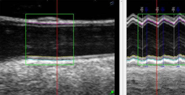 Ultraschallbild der Halsschlagader mit Erkennung der Arterienwand und des Arteriendurchmessers. Links als Standbild, rechts über mehrere Herzzyklen.