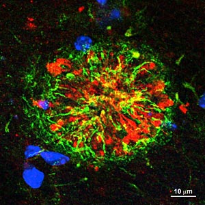 Hirnpräparat einer infizierten transgenen Maus. Die typischen
Beta-Amyloid-Plaques (grün) bilden sich genau an den Stellen, wo sich
durch die Erstinfektion das Amyloid- Precursor-Protein (rot) abnormal
angehäuft hat. Die Zellkerne von benachbarten Nerven- und Gliazellen
sind blau gekennzeichnet. Hirnpräparat einer infizierten transgenen Maus. Die typischen
Beta-Amyloid-Plaques (grün) bilden sich genau an den Stellen, wo sich
durch die Erstinfektion das Amyloid- Precursor-Protein (rot) abnormal
angehäuft hat. Die Zellkerne von benachbarten Nerven- und Gliazellen
sind blau gekennzeichnet.