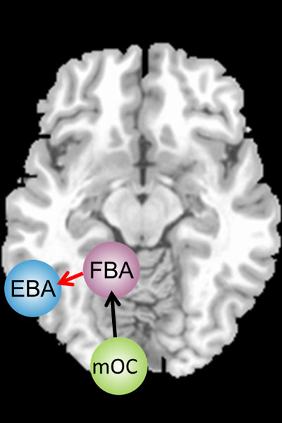 Wenn Menschen Körperbilder betrachten, landen die visuellen Informationen zunächst im mittleren Okzipitallappen (mOC). Die "Fusiform Body Area" (FBA) und die "Extrastriate Body Area" (EBA) verarbeiten die Bilder anschließend weiter. Bei magersüchtigen Frauen ist die Verbindung vom Areal mOC zur FBA unbeeinträchtigt (schwarzer Pfeil). FBA und EBA arbeiten in der linken Hirnhälfte jedoch nicht normal zusammen (roter Pfeil). Wenn Menschen Körperbilder betrachten, landen die visuellen Informationen zunächst im mittleren Okzipitallappen (mOC). Die "Fusiform Body Area" (FBA) und die "Extrastriate Body Area" (EBA) verarbeiten die Bilder anschließend weiter. Bei magersüchtigen Frauen ist die Verbindung vom Areal mOC zur FBA unbeeinträchtigt (schwarzer Pfeil). FBA und EBA arbeiten in der linken Hirnhälfte jedoch nicht normal zusammen (roter Pfeil).