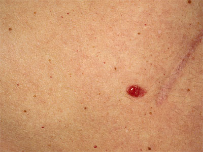 Ansichtssache Hautkrebsvorstufen und weißer Hautkrebs Krebs