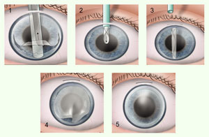 Hornhaut-Transplantation rettet Augenlicht - Chirurgie - derStandard.at › Gesundheit