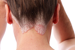 Psoriasis Weit unter die Haut Dermatologie derStandard.at › Gesundheit