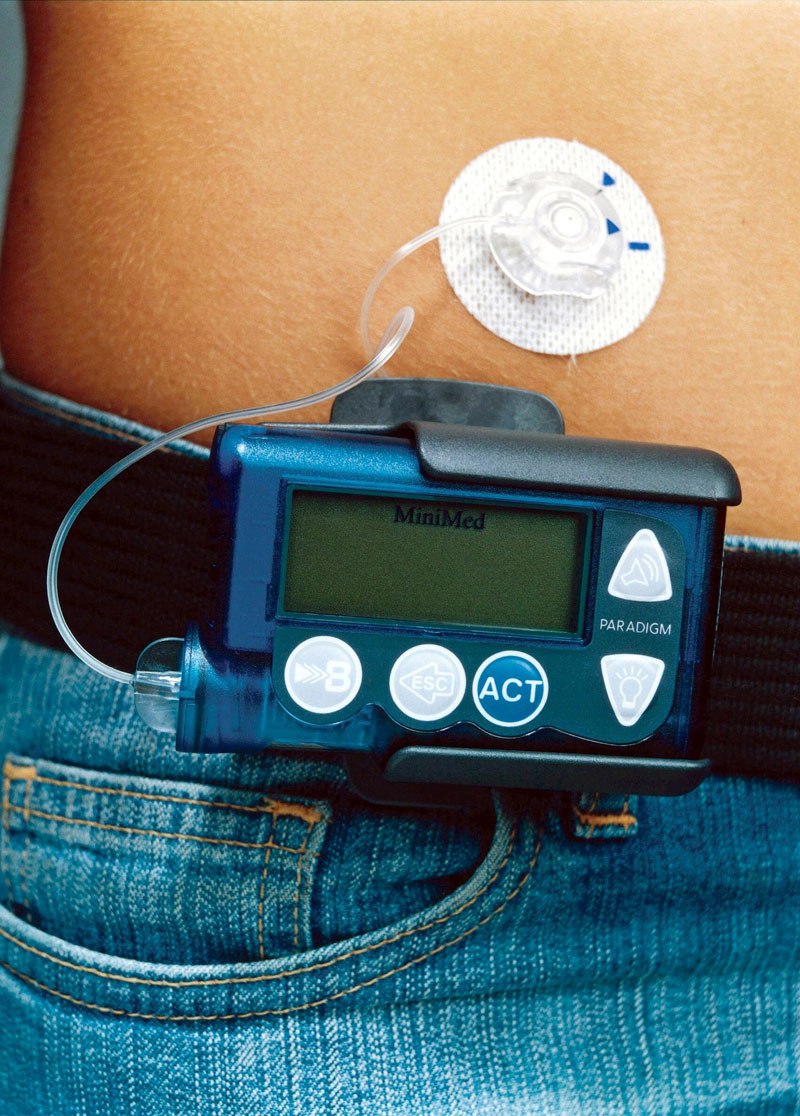 Diabetes: Insulinpumpen retten Menschenleben - Diabetes - derStandard.at › Gesundheit