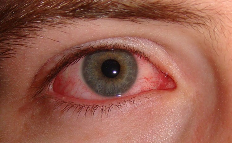 Bindehautentzundung Antibiotische Augentropfen Oft Unnotig Augen Derstandard At Gesundheit
