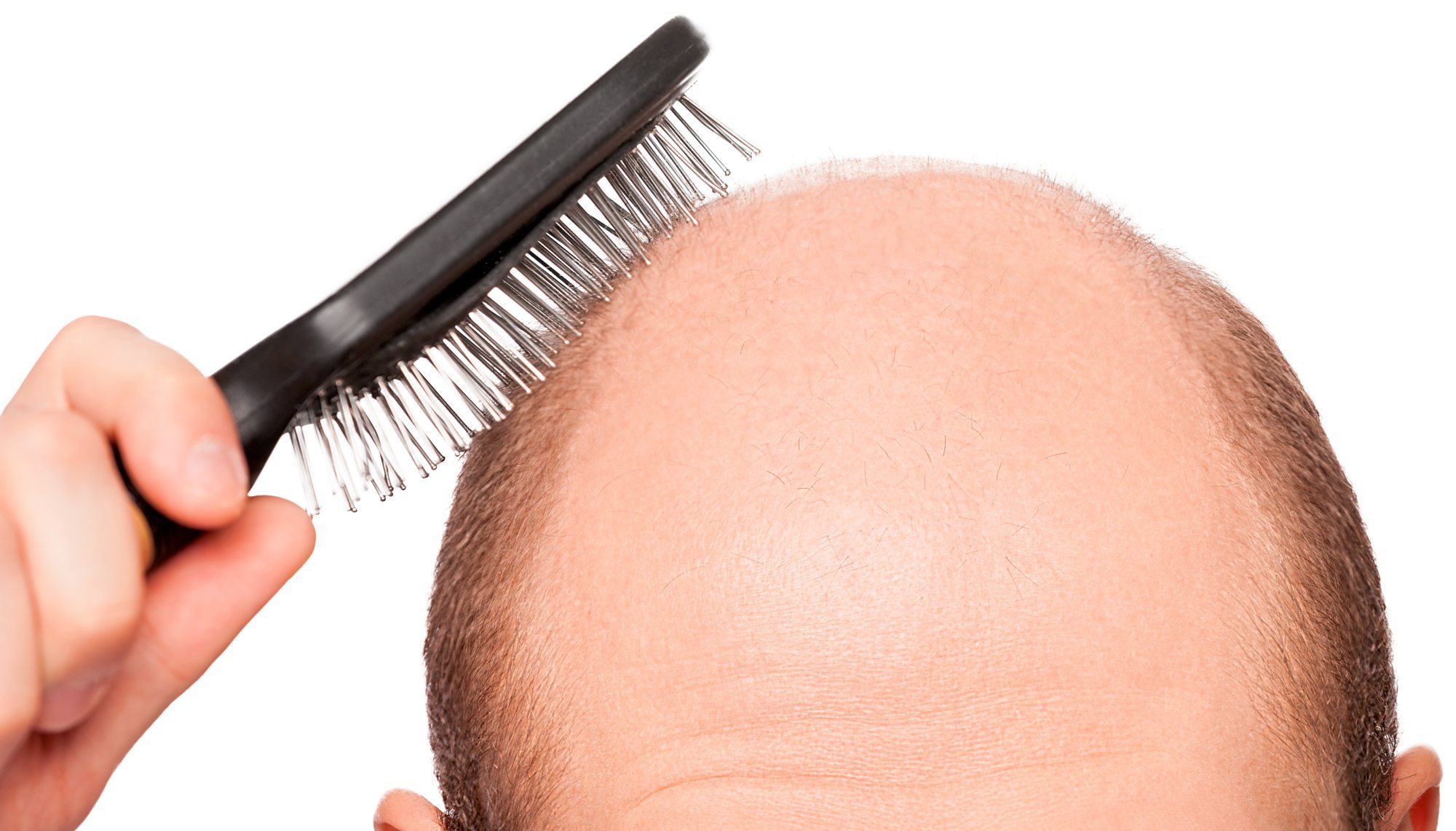 haartransplantation muhsam teuer